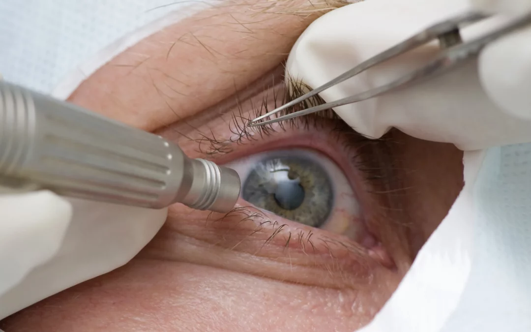 Quels sont les implants oculaires utilisés pour la correction de l’astigmatisme ?