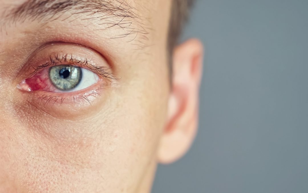 Quelle est la principale cause de la sécheresse oculaire ?