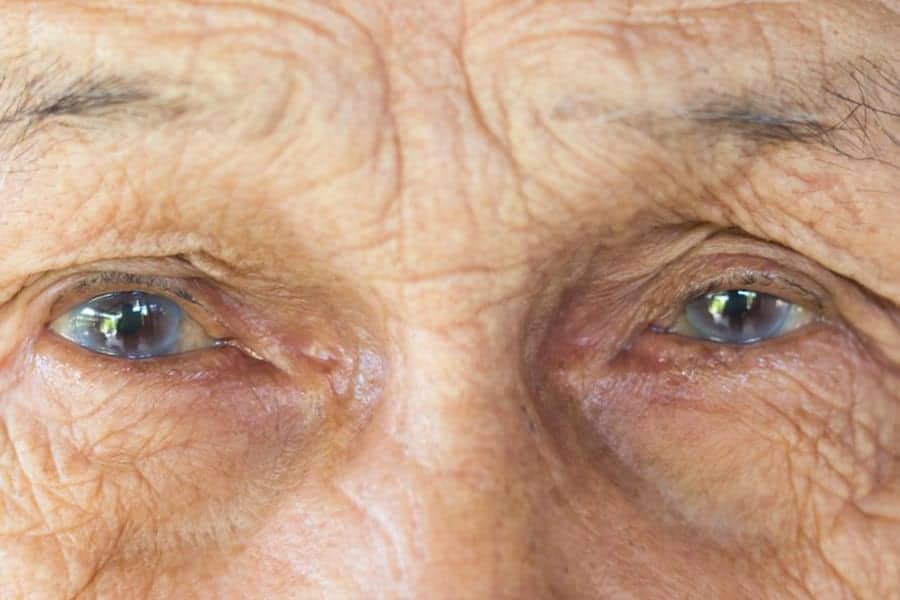 Que faire si les sensations de sécheresse oculaire persistent malgré la rééducation du clignement ?